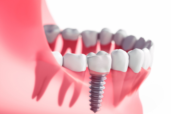 https://cayodental.lk/wp-content/uploads/2023/04/Dental-Implants.png